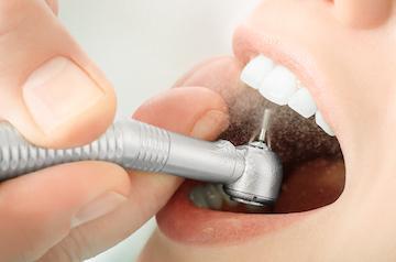 dental procedure | Cosmetic Dentistry in Poway CA | AllDent Dental Center