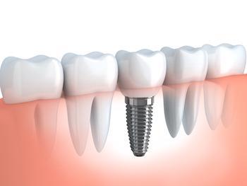 diagram of a dental implant | Dental Implant in Poway CA | AllDent Dental Center